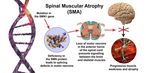 Carrier Screening For Spinal Muscular Atrophy