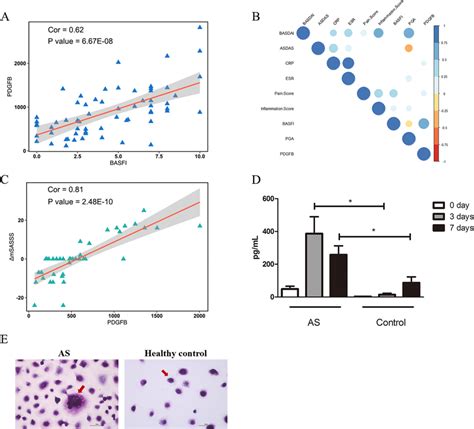 Correlation of PDGFB with clinical indices. A Correlation between PDGFB ...