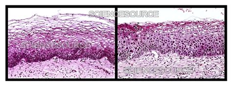 Cervical Intraepithelial Neoplasia Ci Stock Image Science Source Images