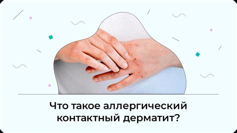 Инфекционный дерматит у детей и взрослых: фото аллергического недуга на ...
