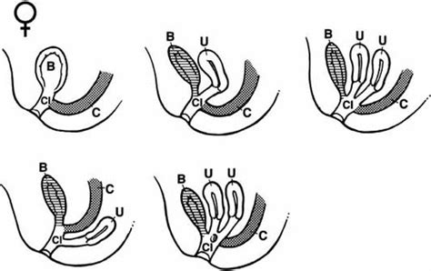 Partial Urorectal Septum Malformation Sequence A Report Of 25 Cases Wheeler 2001 American