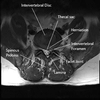 Lumbar Spine Hemilaminectomy Surgery - Complete Orthopedics