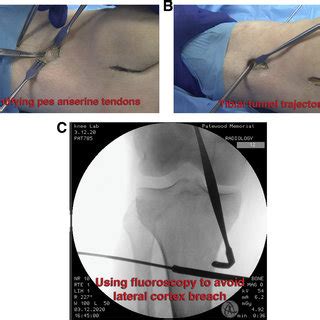 A Intraoperative Photograph Showing The Minimally Invasive Tibial