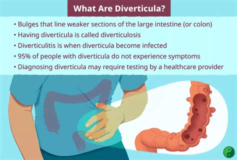 Diverticulitis Causes Symptoms Treatment And Care Philadelphia