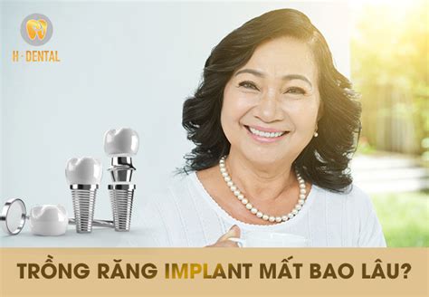 Trồng Răng Implant Mất Bao Lâu Địa Chỉ Trồng Implant Nhanh