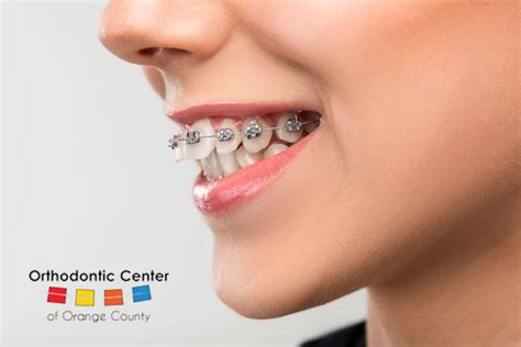 Orthodontists And Braces In Oc Braces On Crooked Teeth