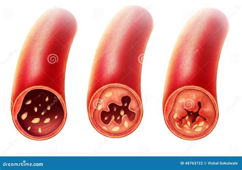 Anatomy Of Atherosclerosis In Artery Stock Illustration Image 48763722