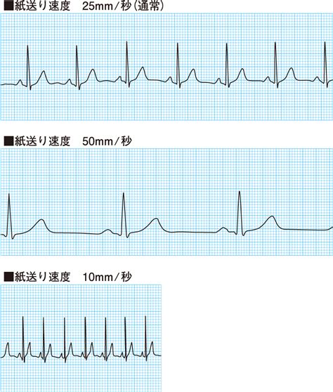 心電図波形の名称と成り立ち｜心電図とはなんだろう（2） 看護roo カンゴルー