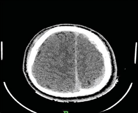 Plain Ct Brain Showing Left Frontotemporoparietal Ftp Acute Subdural Download Scientific