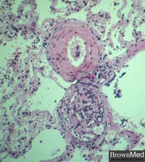 Pulmonary Artery Histology