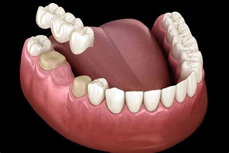 What Are Dental Bridges And Are They For You Dental Matters