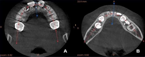 Axial Cbct Section Of Maxillary A And Mandibular B Arches