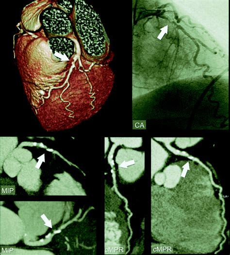 High Resolution Spiral Computed Tomography Coronary Angiography In