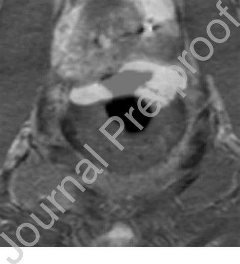 Sagittal A And Axial B Follow Up Contrast Enhanced Ct Images At 7