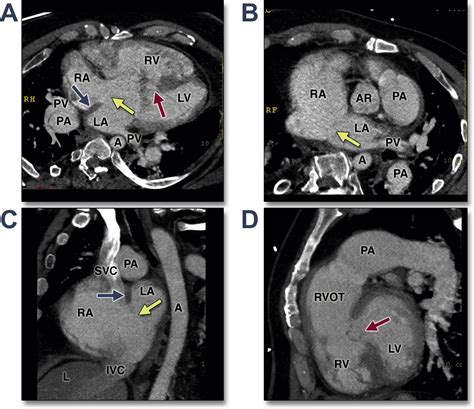 Imaging Of Adult Atrial Septal Defects With CT Angiography JACC