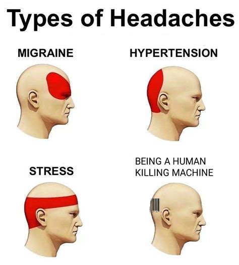 Headache Chart: What Does Headache Location Mean?