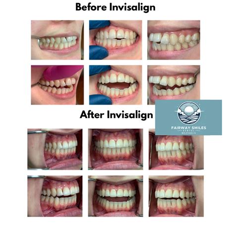 Midlothian Invisalign Success Story Fairway Smiles