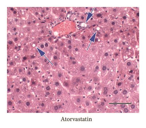 Effect Of BuShenKangShuai Tablet BSKS On The Hepatic Steatosis In