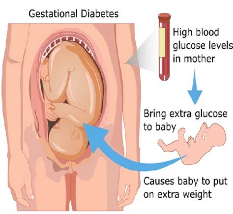 Gestational Diabetes Treatment In Ram Mohan Dutta Road Kolkata ID