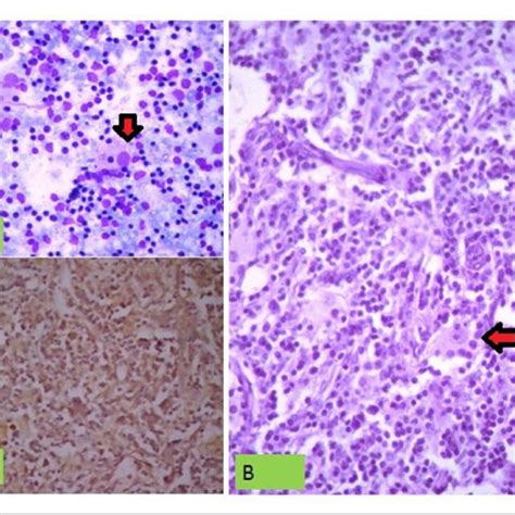 A 60x Fine Needle Aspiration Cytology Cervical Lymph Node Giemsa Download Scientific Diagram