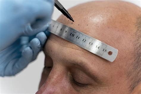 Best Hair Transplant Clinics And Surgeons In Tennessee Cibo Clinic