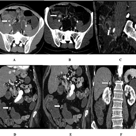 Ct Scan Arterial Phase A B Axial And C Cmpr Of One Patient With