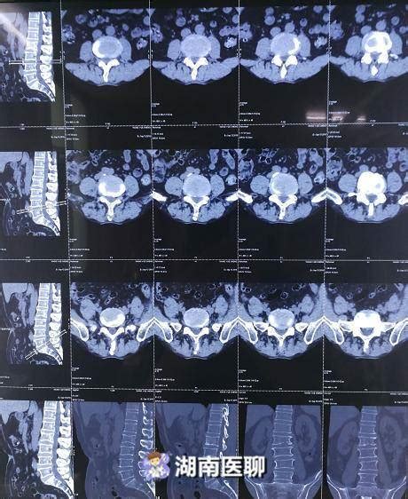 腰肌劳损痛点图片 腰肌劳损瑜伽动作图片 骶棘肌位置图 第8页 大山谷图库