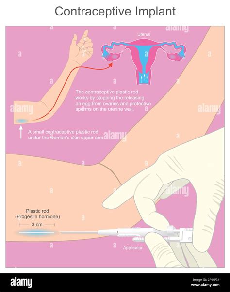 Implante Anticonceptivo Una Peque A Varilla De Pl Stico Anticonceptivo