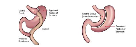 Bariatric Surgery: What Are My Options? - Arkansas Heart Hospital