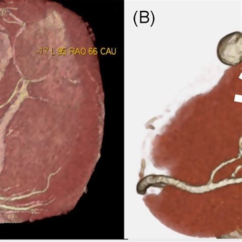 A Coronary Ct Scan Obtained At The Time Of Previous Surgery Showing