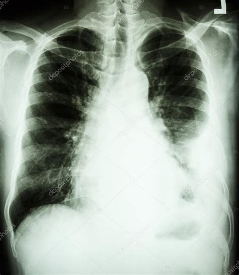 Pleural Effusion At Left Lung Due To Lung Cancer — Stock Photo 61366841