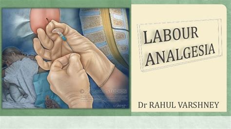 Labour Analgesia