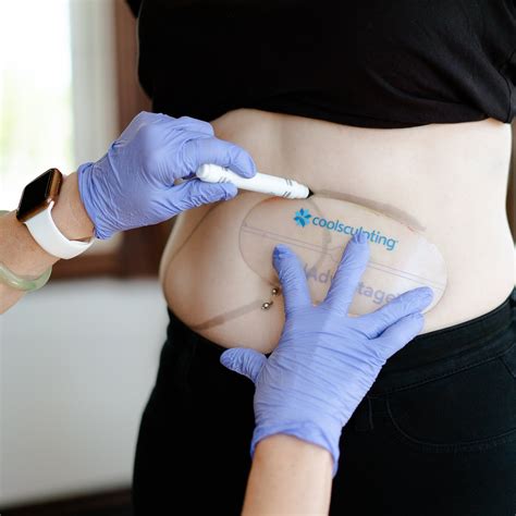 CoolSculpting® Experts in Edmonton, St. Albert & Kelowna — External Affairs
