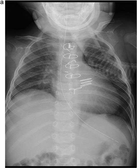 Case An Month Old Male With Right Diaphragmatic Paralysis Chest