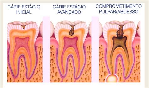 Como Se Desenvolve A C Rie Dom Odontologia Avan Ada Sa De Bucal