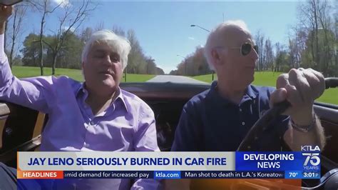 Jay Leno Suffers Serious Burns In Fire Youtube