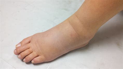 Kidney Disease Causes And Treatments Revascular