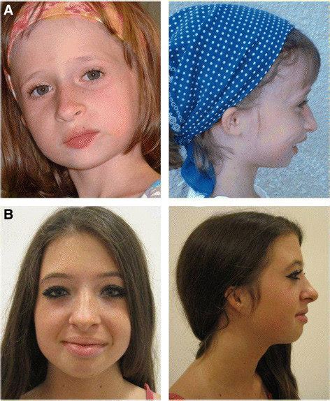 Facial Features Of Meier Gorlin Syndrome Patient A Is A Girl Aged