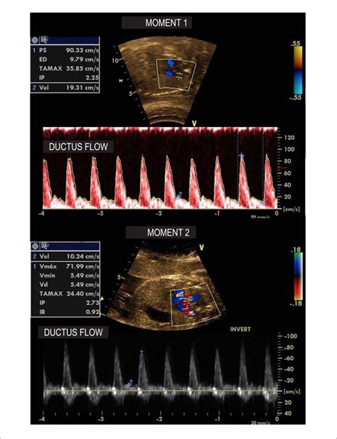 Doppler Echocardiographic Findings In A 29 Week Fetus Before And Two Download Scientific