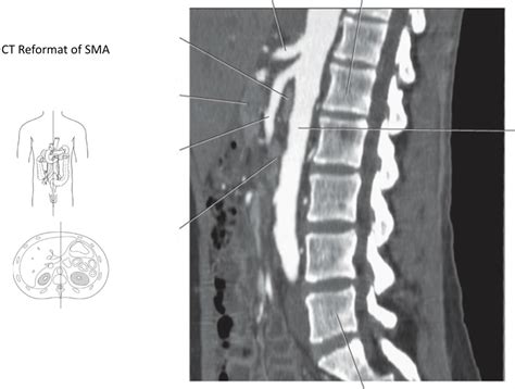 ct reformat  sma diagram quizlet