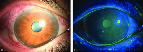 Subepithelial Infiltrates Staining