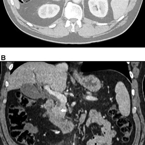 A Contrast Enhanced Axial Ct Image In The Portal Venous Phase Download Scientific Diagram