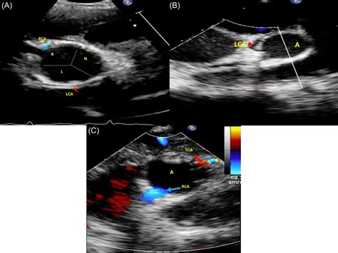 Imaging Findings Preoperative Transthoracic Echocardiography A