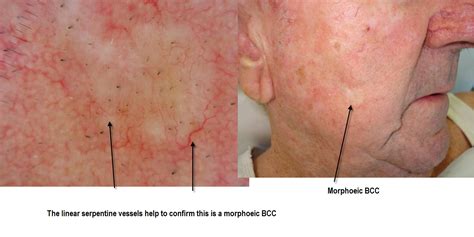 Dermoscopy Made Simple Basal Cell Carcinoma