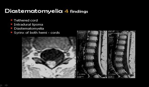 Diastematomyelia | Pathology, Radiology, Historical figures