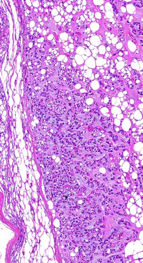 Pathology Of Chondroid Lipoma Histology Slides Rocks And Crystals