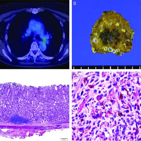 Positron Emission Tomography Computed Tomography Images And Endoscopic Download Scientific