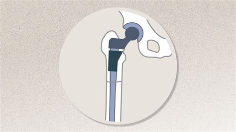 Ao Recon Course Complex Total Hip And Knee Arthroplasty