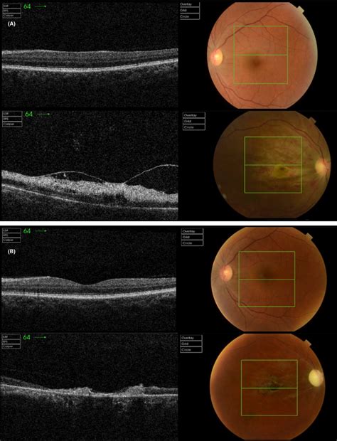 A OCT Of The Right And Left Eye At Presentation Note The Presence Of