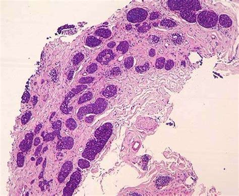 Adenoid Cystic Carcinoma Breast Core Biopsy 69yo Female